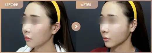 Thread lifting · 02: before-and-after comparison at Newstar Clinic
