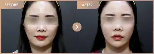 Thread lifting · 01: before-and-after comparison at Newstar Clinic
