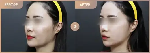 Thread lifting · 02: before-and-after comparison at Newstar Clinic