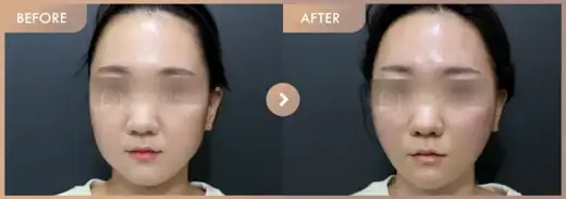 Thread lifting · 01: before-and-after comparison at Newstar Clinic