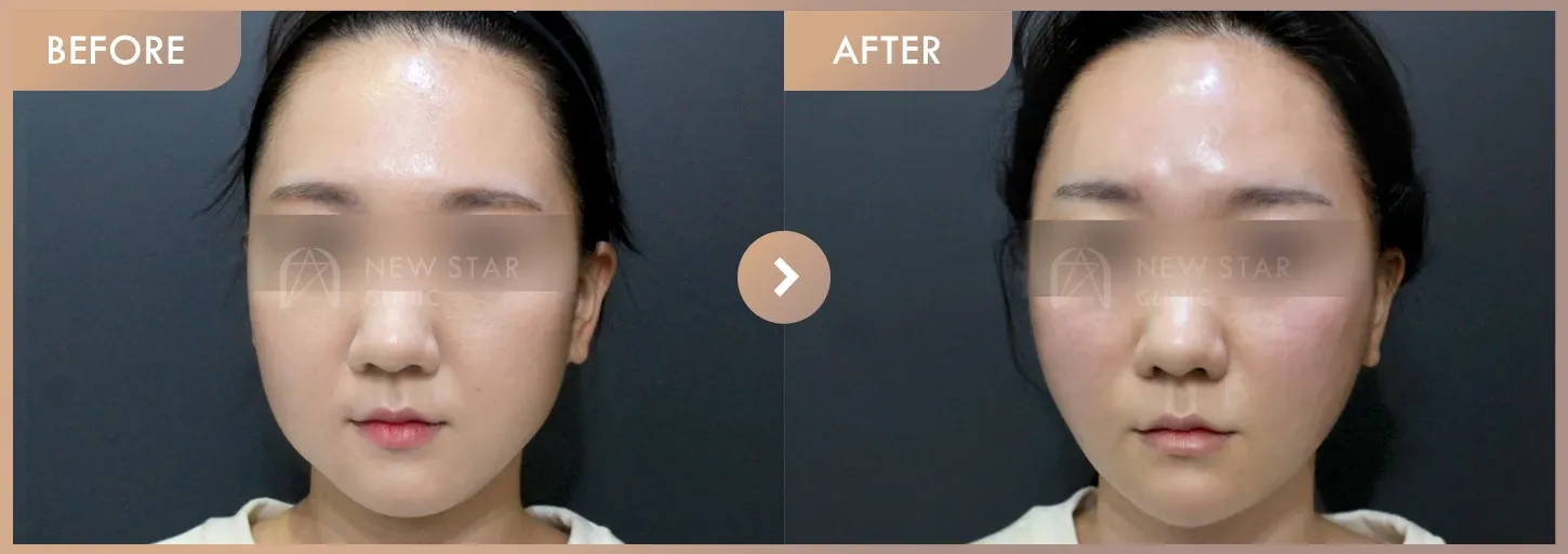 Thread lifting · 01 before-and-after photos at Newstar Clinic