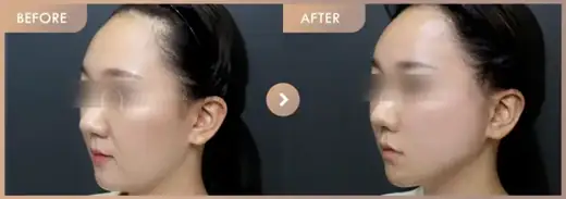 Thread lifting · 02: before-and-after comparison at Newstar Clinic