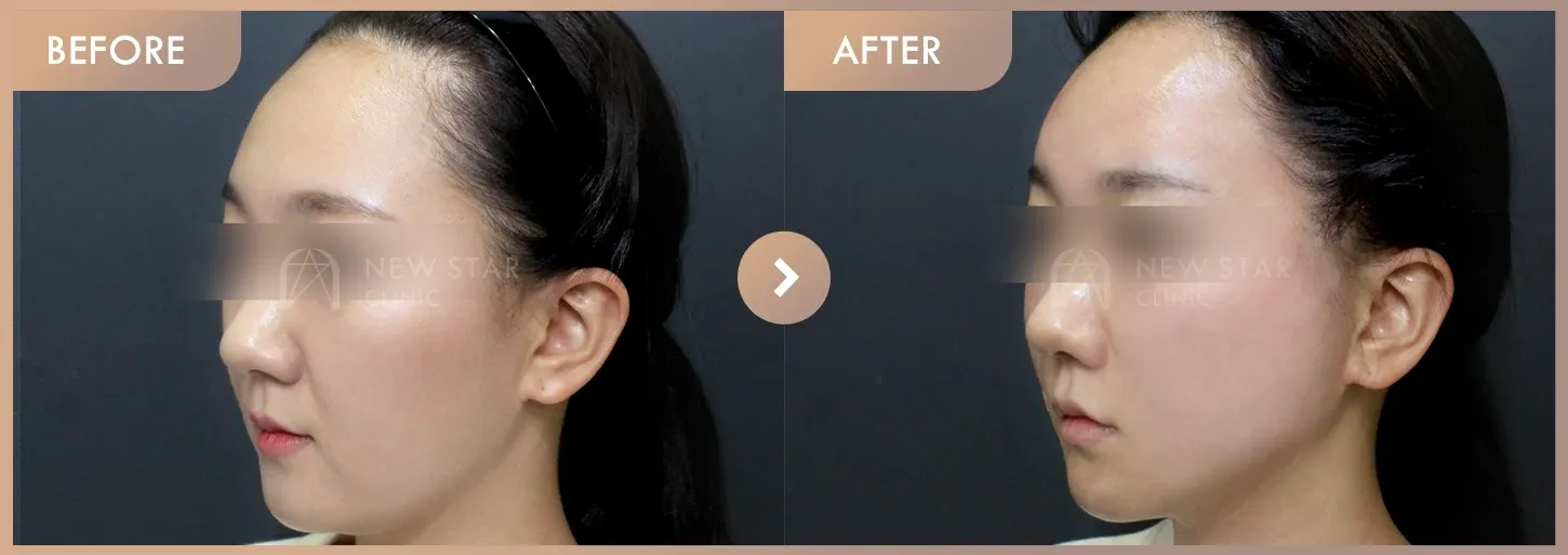 Thread lifting · 02 before-and-after photos at Newstar Clinic