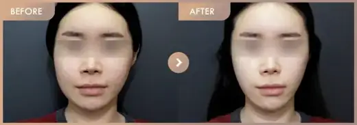 Thread lifting · 01: before-and-after comparison at Newstar Clinic
