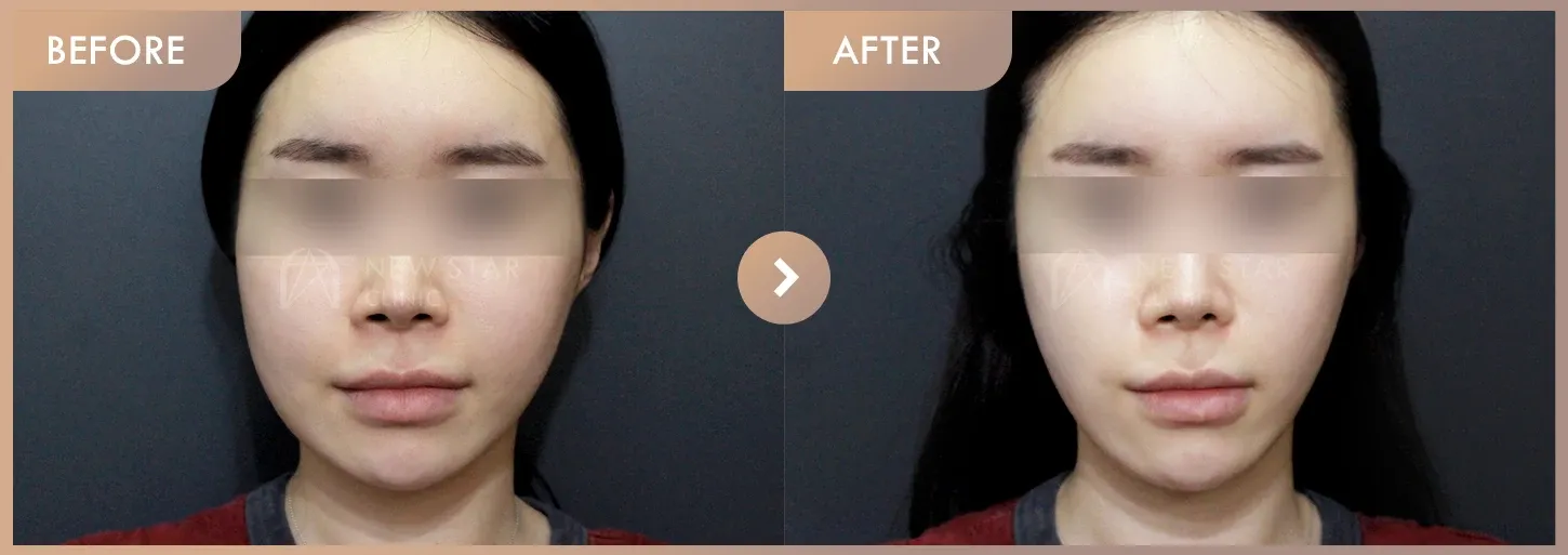 Thread lifting · 01 before-and-after photos at Newstar Clinic
