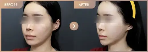Thread lifting · 02: before-and-after comparison at Newstar Clinic