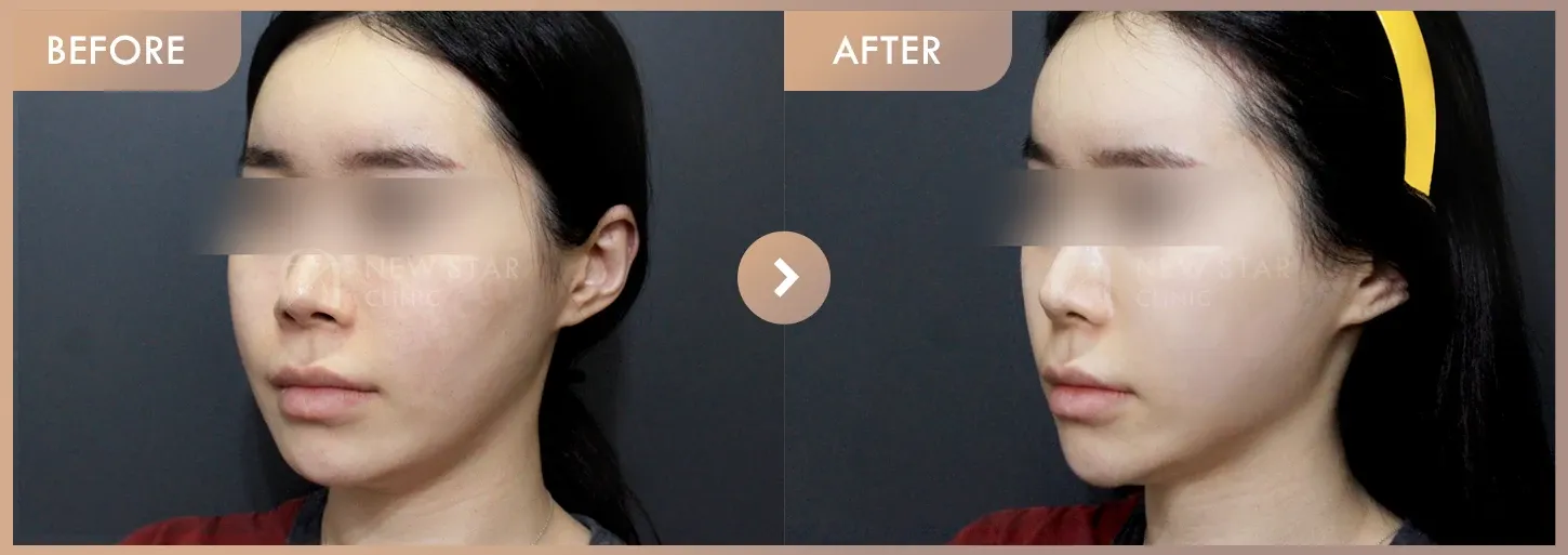 Thread lifting · 02 before-and-after photos at Newstar Clinic