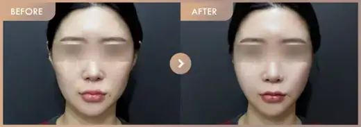 Thread lifting · 01: before-and-after comparison at Newstar Clinic