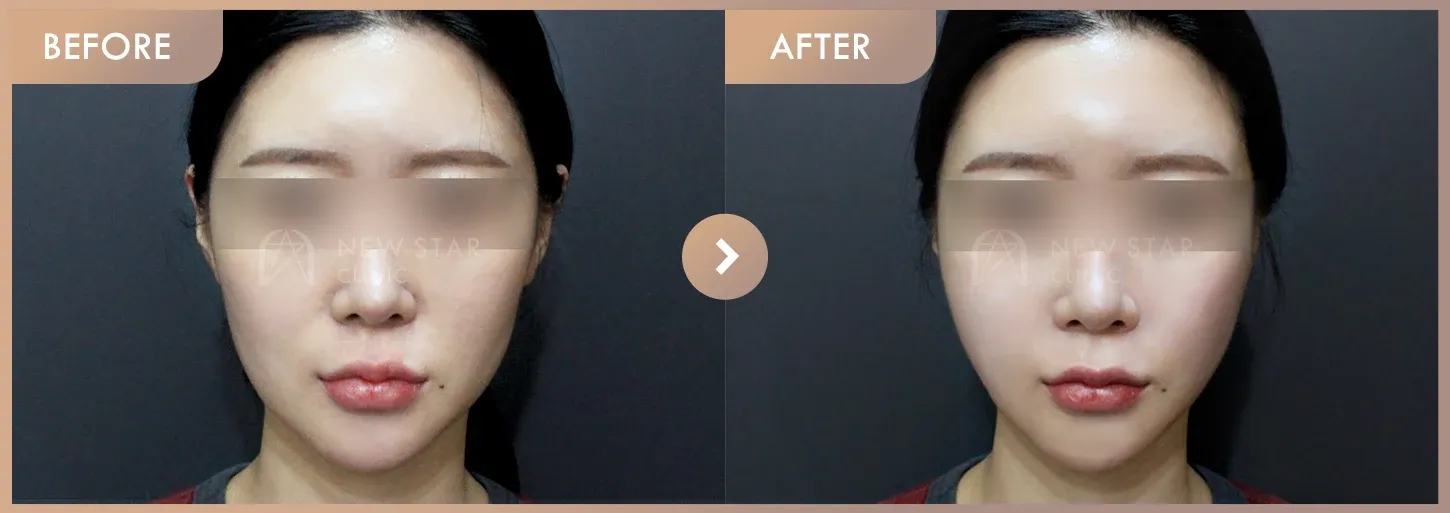 Thread lifting · 01 before-and-after photos at Newstar Clinic
