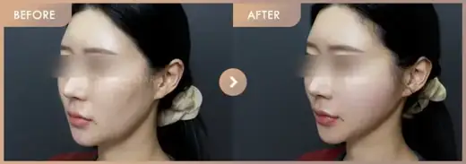Thread lifting · 02: before-and-after comparison at Newstar Clinic