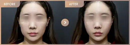 Thread lifting · 01: before-and-after comparison at Newstar Clinic
