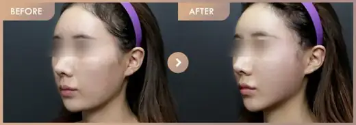 Thread lifting · 02: before-and-after comparison at Newstar Clinic