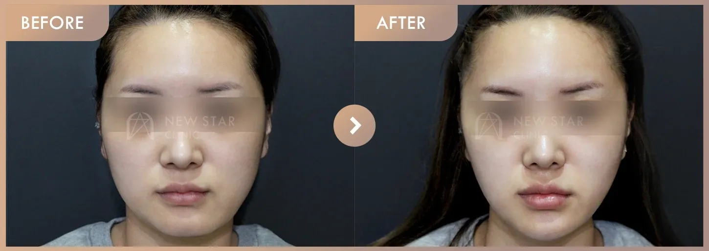 Thread lifting · 01 before-and-after photos at Newstar Clinic