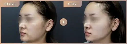 Thread lifting · 02: before-and-after comparison at Newstar Clinic