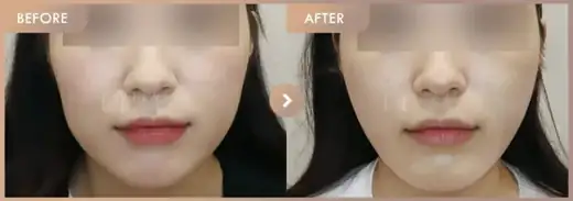 Thread lifting · 01: before-and-after comparison at Newstar Clinic