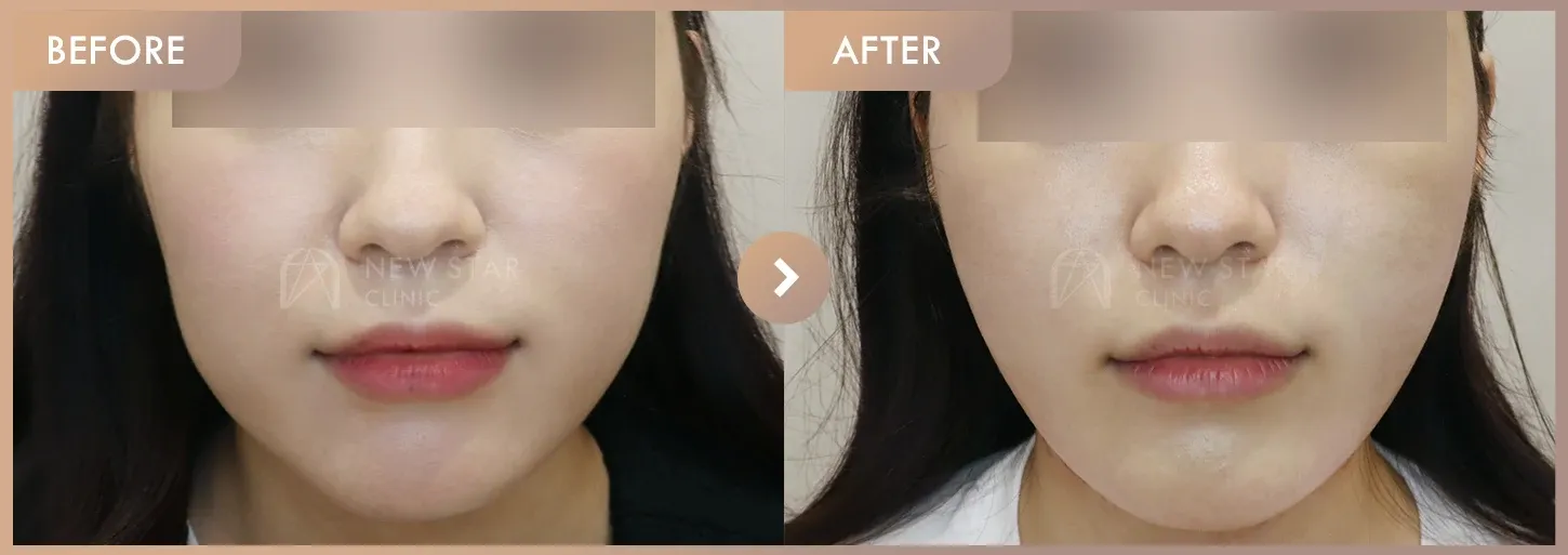 Thread lifting · 01 before-and-after photos at Newstar Clinic