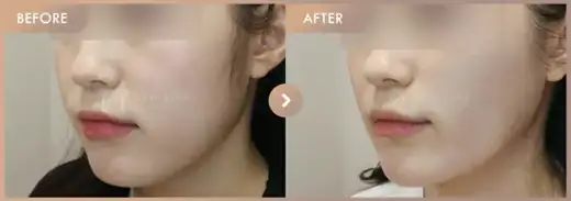 Thread lifting · 02: before-and-after comparison at Newstar Clinic