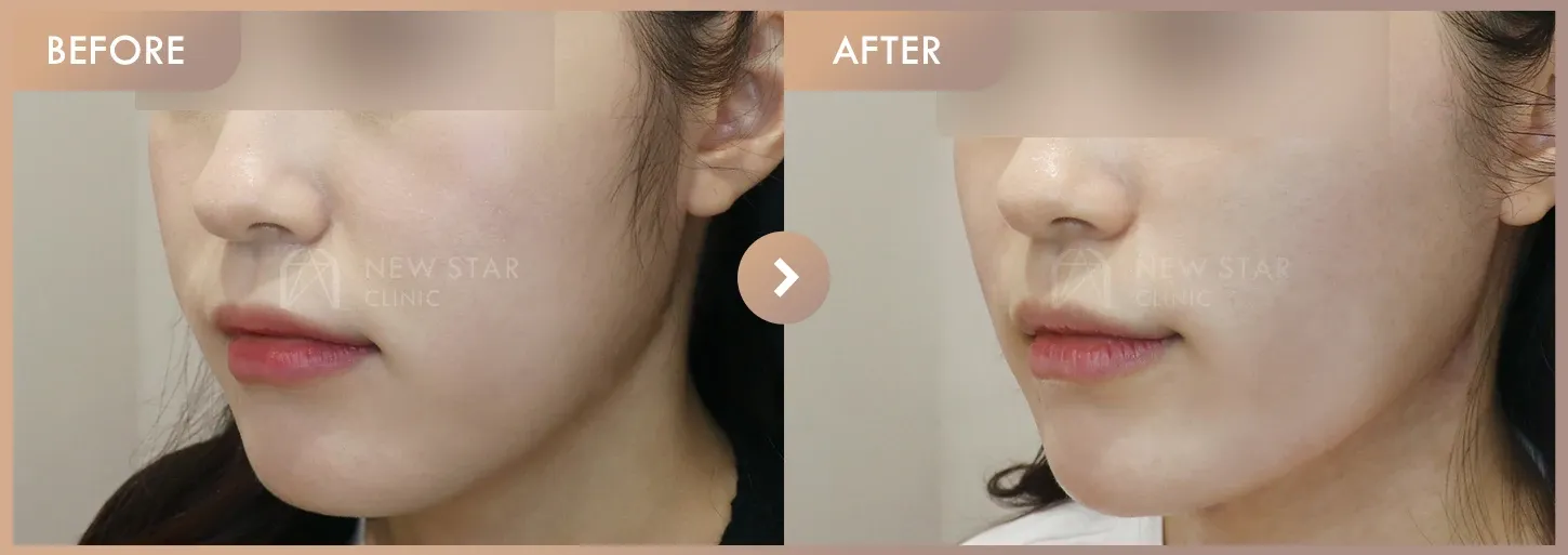 Thread lifting · 02 before-and-after photos at Newstar Clinic