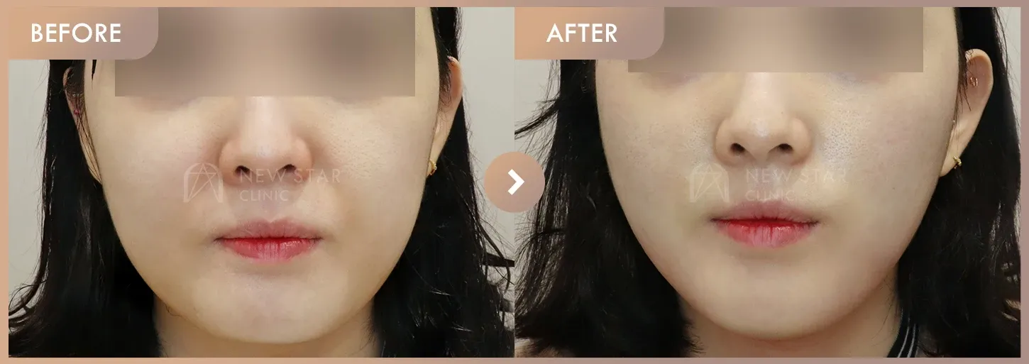 Thread lifting · 01 before-and-after photos at Newstar Clinic