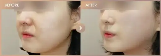Thread lifting · 02: before-and-after comparison at Newstar Clinic