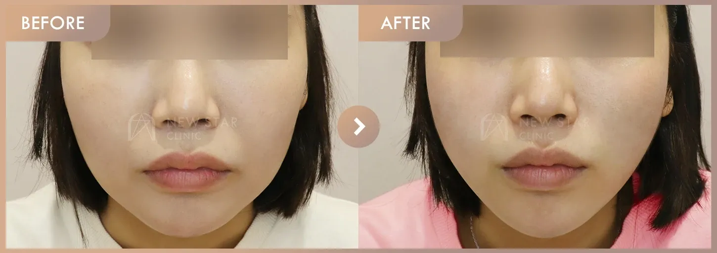 Thread lifting · 01 before-and-after photos at Newstar Clinic