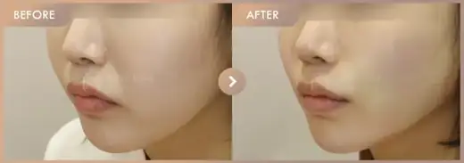 Thread lifting · 02: before-and-after comparison at Newstar Clinic