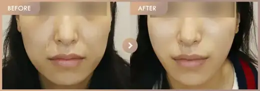 Thread lifting: before-and-after comparison at Newstar Clinic