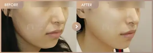 Thread lifting: before-and-after comparison at Newstar Clinic