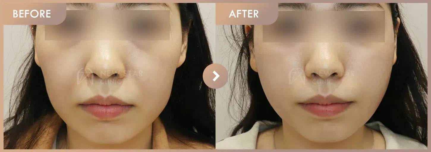 Thread lifting before-and-after photos at Newstar Clinic