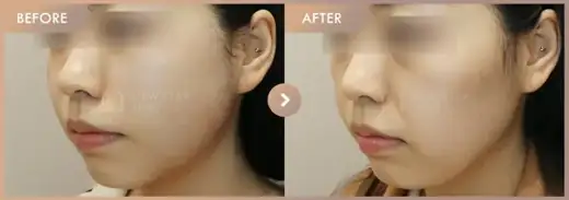 Thread lifting: before-and-after comparison at Newstar Clinic