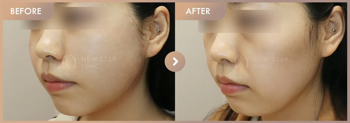 Thread lifting before-and-after photos at Newstar Clinic