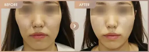 Thread lifting: before-and-after comparison at Newstar Clinic