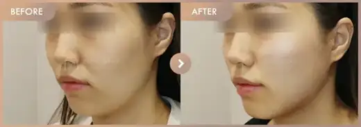 Thread lifting: before-and-after comparison at Newstar Clinic