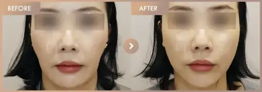 Thread lifting: before-and-after comparison at Newstar Clinic