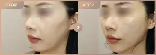 Thread lifting: before-and-after comparison at Newstar Clinic