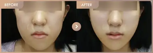 Thread lifting: before-and-after comparison at Newstar Clinic