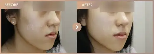 Thread lifting: before-and-after comparison at Newstar Clinic