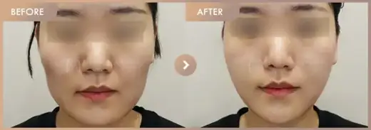 Thread lifting · 01: before-and-after comparison at Newstar Clinic
