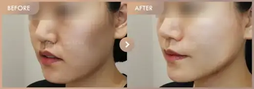 Thread lifting · 02: before-and-after comparison at Newstar Clinic