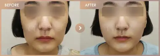 Thread lifting: before-and-after comparison at Newstar Clinic