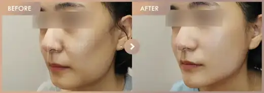 Thread lifting: before-and-after comparison at Newstar Clinic