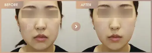 Thread lifting: before-and-after comparison at Newstar Clinic