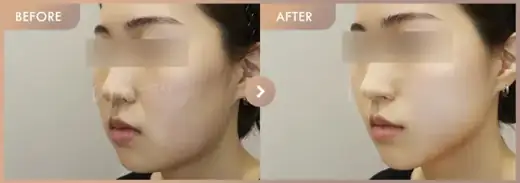 Thread lifting: before-and-after comparison at Newstar Clinic