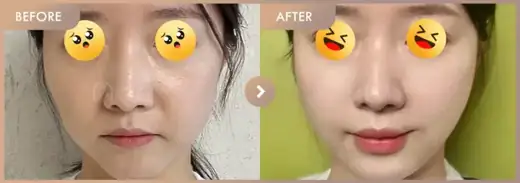 Thread lifting: before-and-after comparison at Newstar Clinic