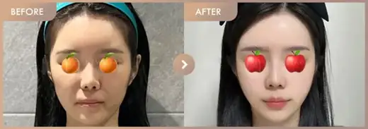 Thread lifting: before-and-after comparison at Newstar Clinic
