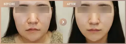 ONDA lifting + Thread lifting · 01: before-and-after comparison at Newstar Clinic