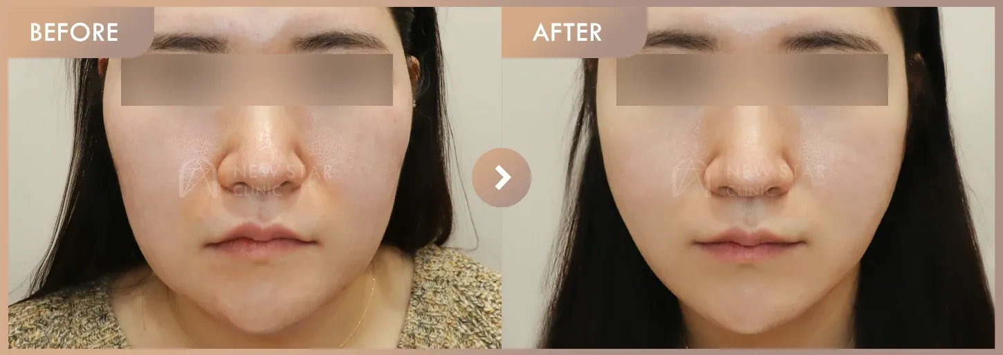 ONDA lifting + Thread lifting · 01 before-and-after photos at Newstar Clinic