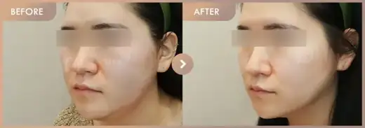 ONDA lifting + Thread lifting · 02: before-and-after comparison at Newstar Clinic