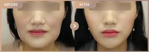 Thread lifting: before-and-after comparison at Newstar Clinic