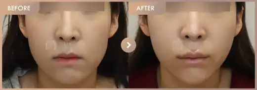 Thread lifting: before-and-after comparison at Newstar Clinic